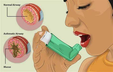 Asthma